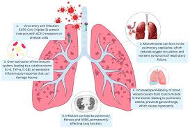 A Comprehensive Guide to Bacterial Pneumonia