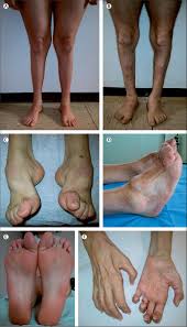 Understanding Charcot Marie Tooth Disease: Symptoms and Treatments