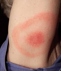 Understanding Lyme Disease: Symptoms, Treatment, and Prevention