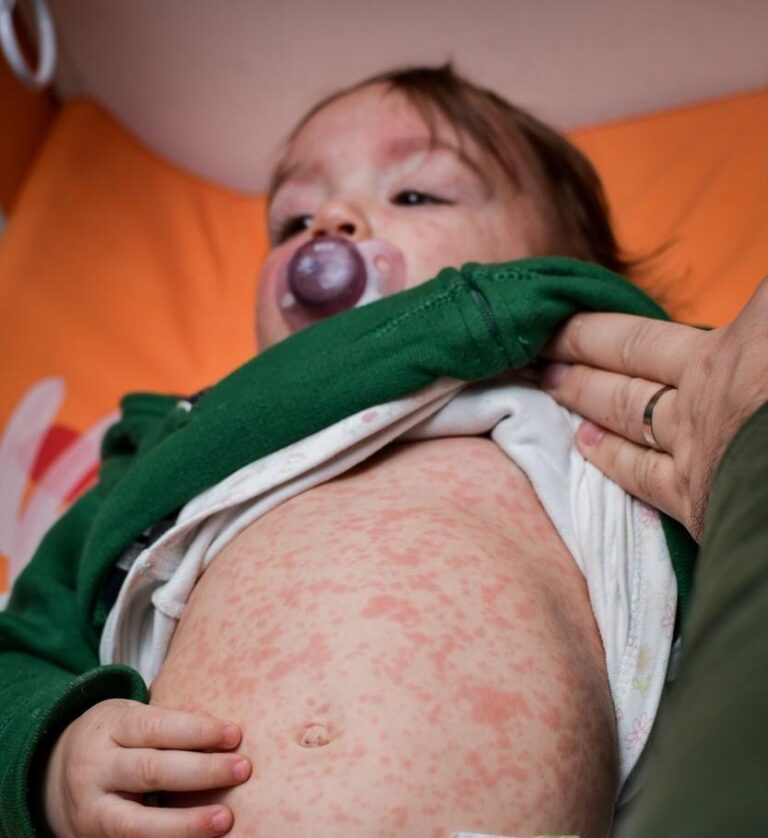 Measles: An Urgent Public Health Challenge