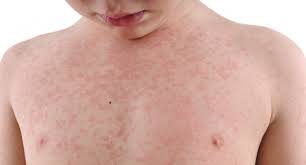 Understanding the Recent Measles Outbreaks