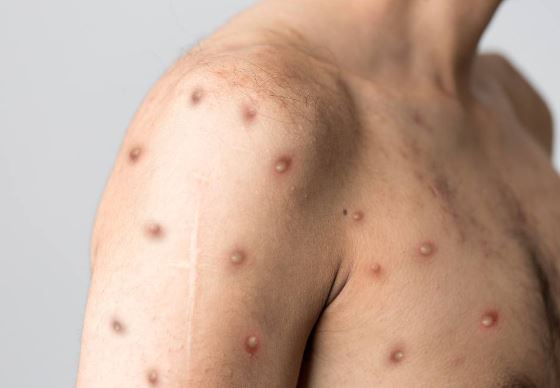 Understanding the Current Monkeypox Outbreaks and Health Risks