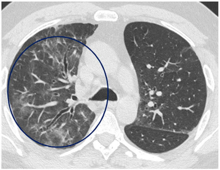 Everything You Need to Know About Pneumonia