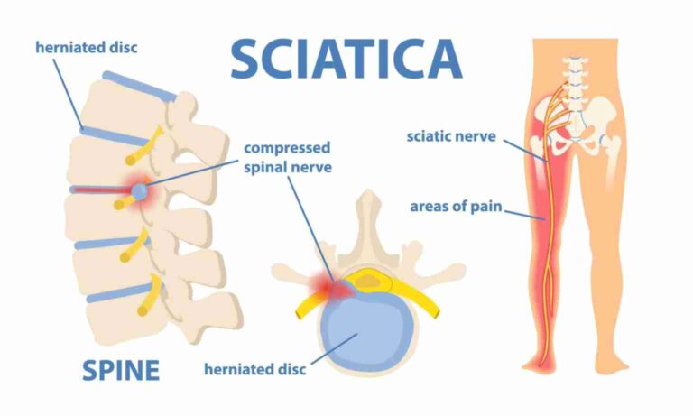 A Comprehensive Guide to Sciatica: Understanding and Managing Pain
