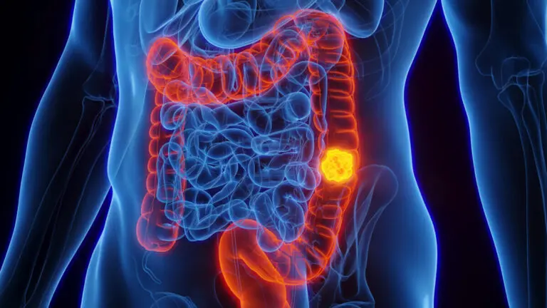 Understanding Colorectal Cancer: Trends and Insights