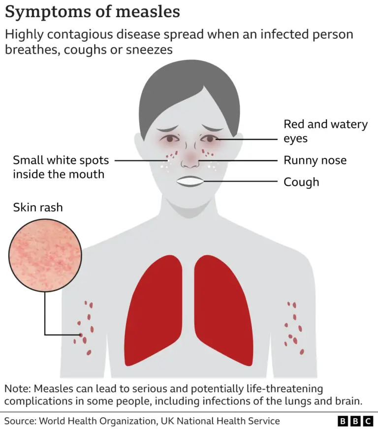 Recognizing Measles Symptoms: A Public Health Concern