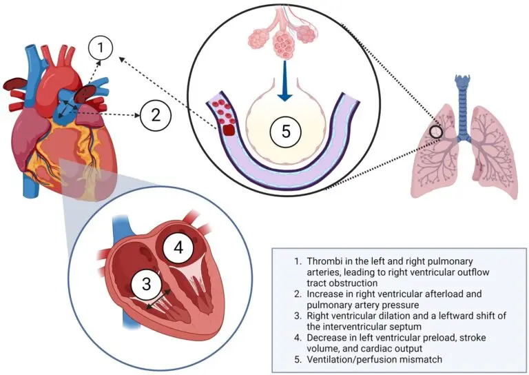 What You Need to Know About Pulmonary Embolism